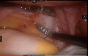 Treatment for Endometriosis